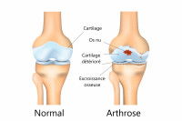 Schéma d'une articulation avec de l'arthrose