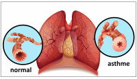 Schéma des bronches avec et sans asthme