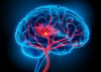 Schéma d'un AVC dans un cerveau