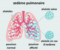 Schéma illustrant un oedème pulmonaire