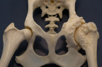 Une hanche normale à gauche, et une rongée par l'arthrose à droite