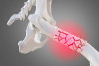 Schéma d'un os de chien avec une fracture