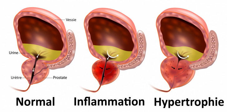 Qu'est-ce que l'hypertrophie bénigne de la prostate ?