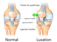 Schéma d'une luxation de la rotule