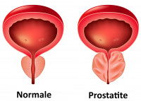 Schéma d'une prostate normale et malade d'une prostatite