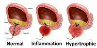 Schéma d'une prostate avec une inflamamtion puis une hypertrophie