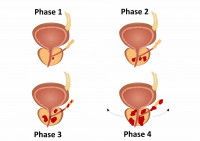 Schéma de l'évolution du cancer de la prostate