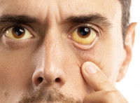 Un homme avec une jaunisse a les yeux jaunes