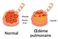 Schéma montrant une alvéole en cas d'oedème pulmonaire