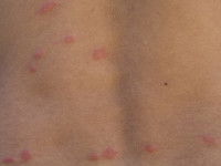 Des boutons dû à un grattage