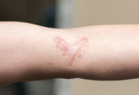 Une cicatrice de morsure de chien sur un bras