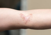 Une grosse cicatrice de morsure de chien sur un bras